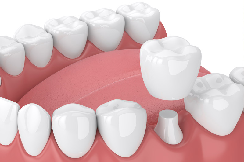 Dental Crowns in South San Francisco