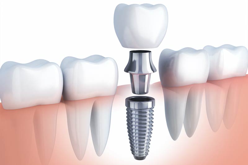 Implants Dentist in South San Francisco
