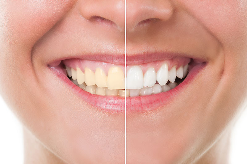 Teeth Whitening in South San Francisco