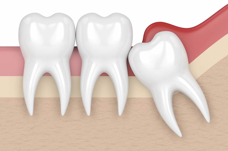 Wisdom Tooth Removal in South San Francisco